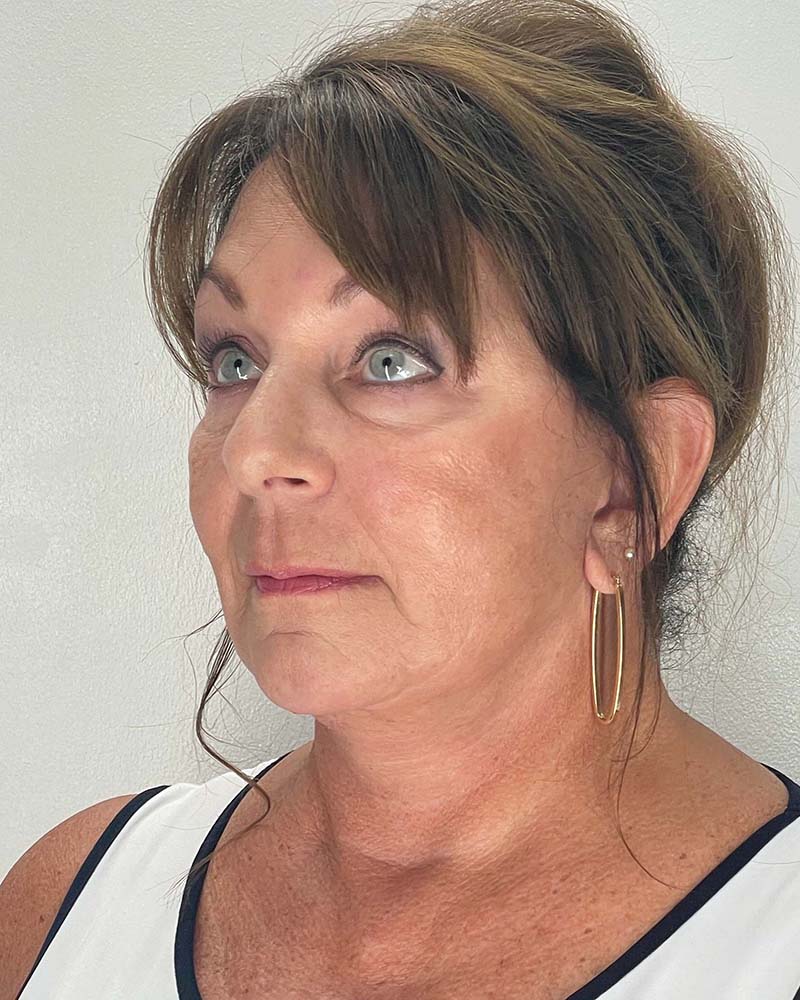 Facelift Before & After Image