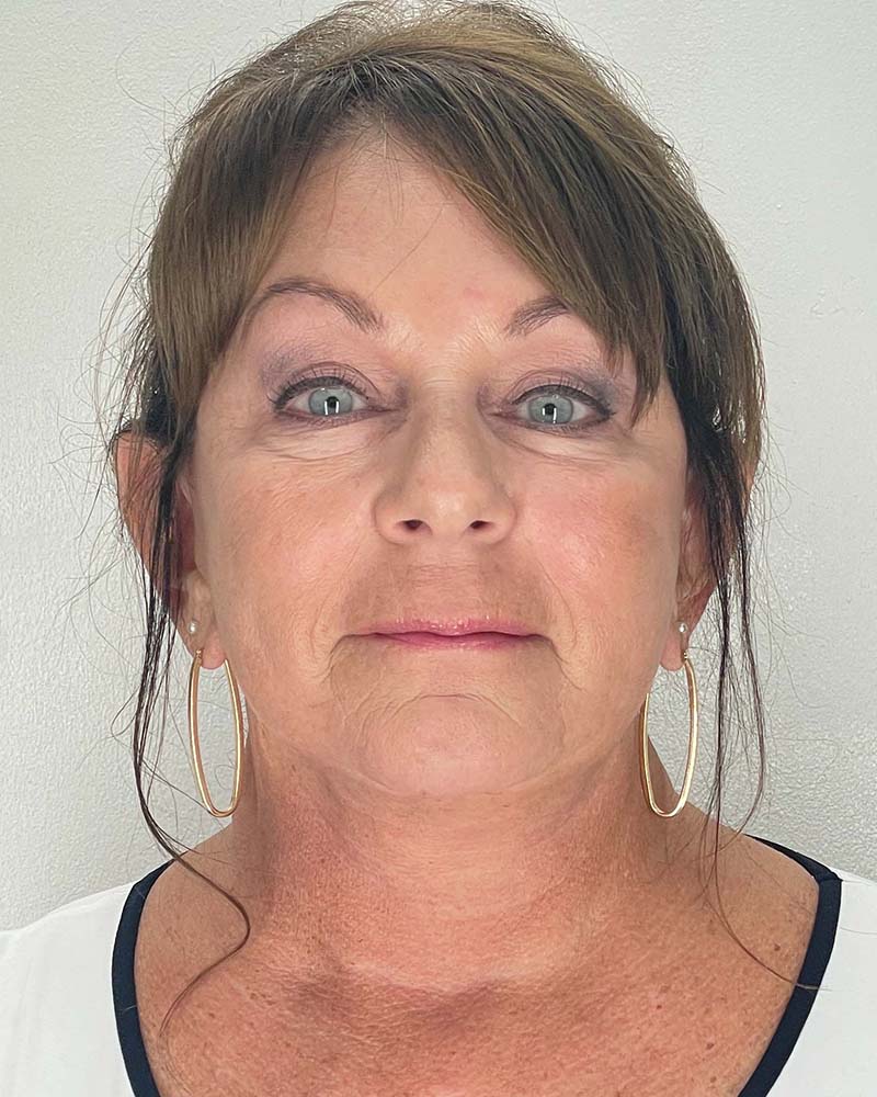 Facelift Before & After Image