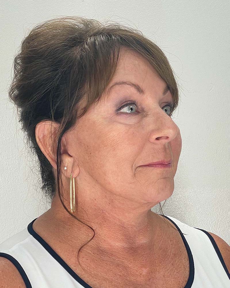 Facelift Before & After Image