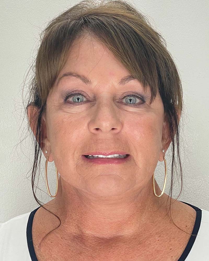 Facelift Before & After Image