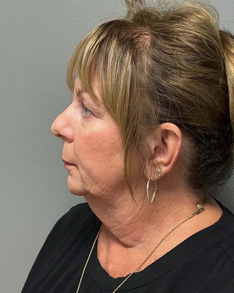 Facelift Before & After Image