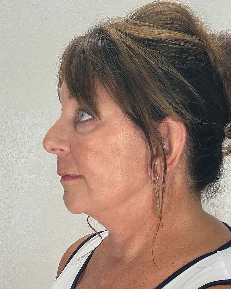 Facelift Before & After Image