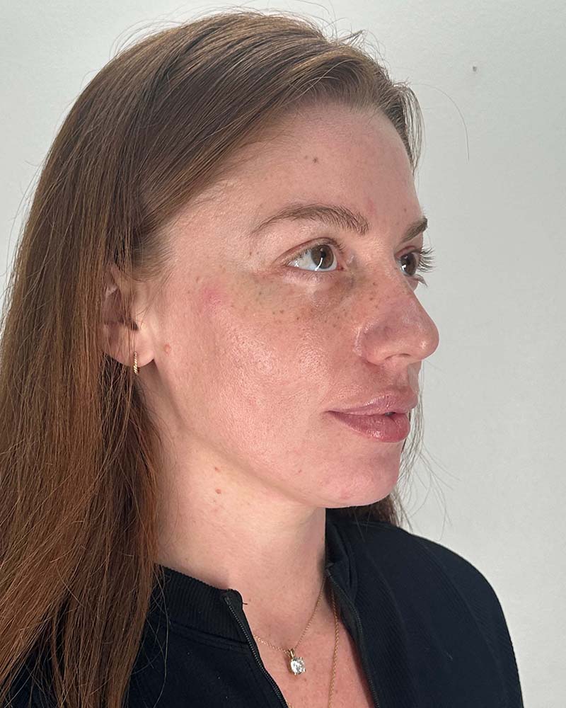 Fat Grafting to Face Before & After Image