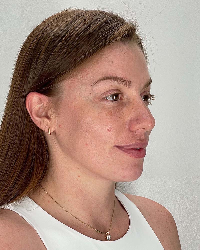 Fat Grafting to Face Before & After Image