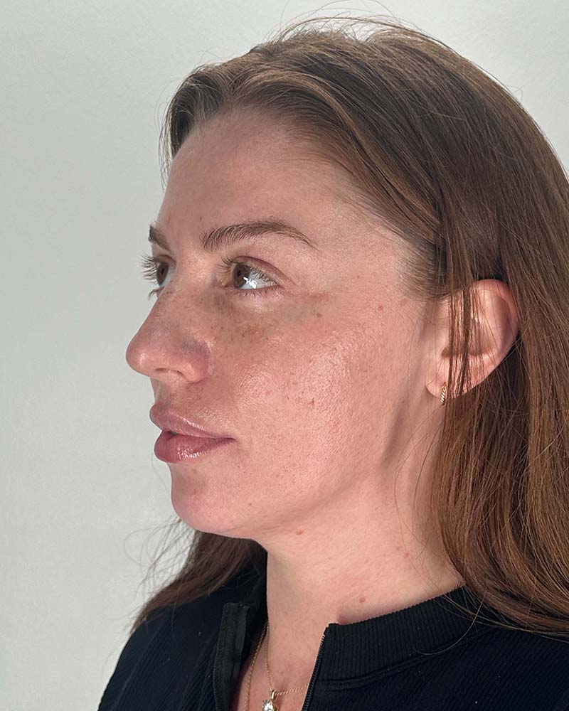 Fat Grafting to Face Before & After Image