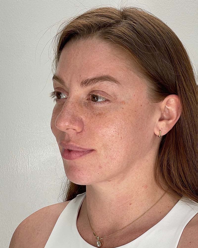 Fat Grafting to Face Before & After Image