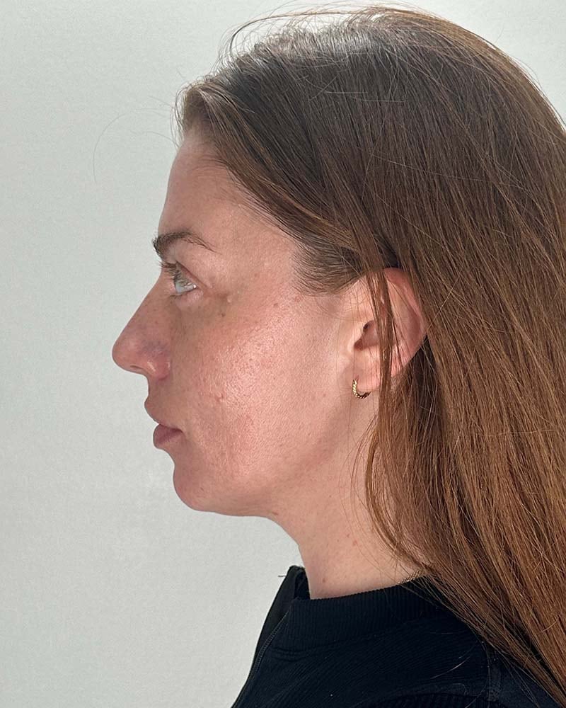 Fat Grafting to Face Before & After Image