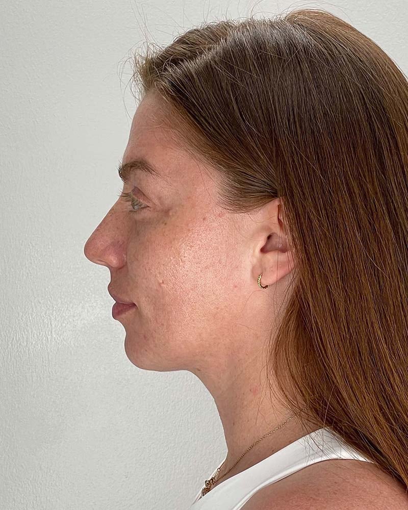 Fat Grafting to Face Before & After Image
