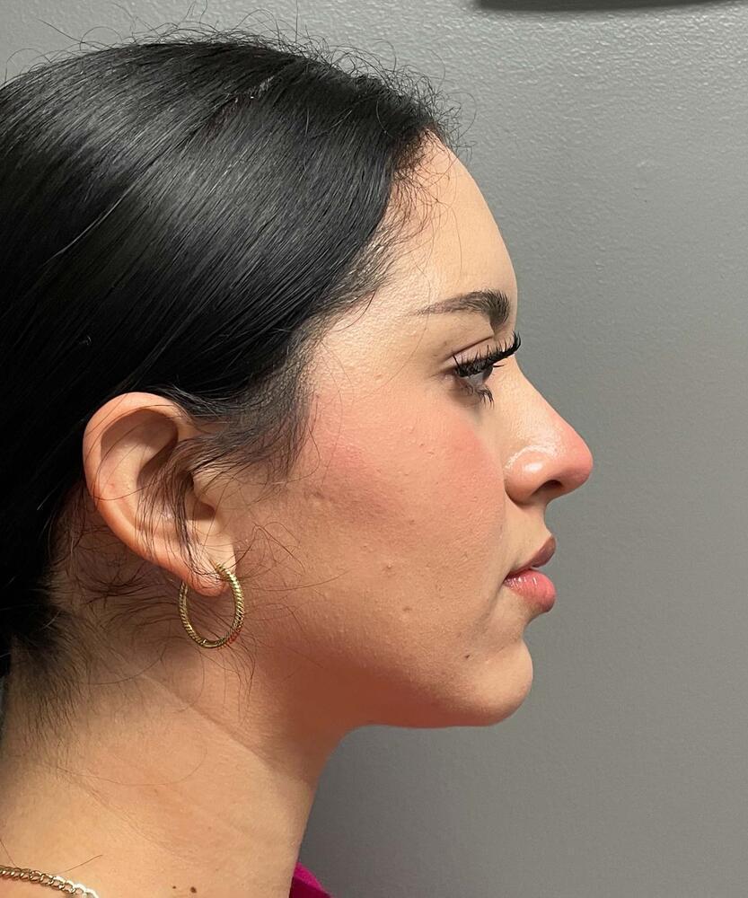 Sculptra Before & After Image