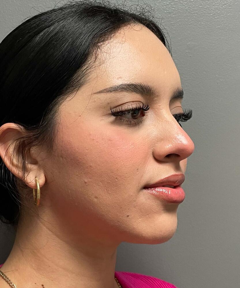 Rhinoplasty Before & After Image