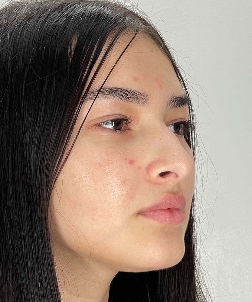 Rhinoplasty Before & After Image