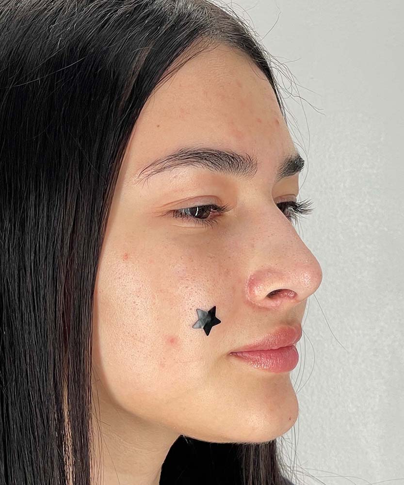 Rhinoplasty Before & After Image