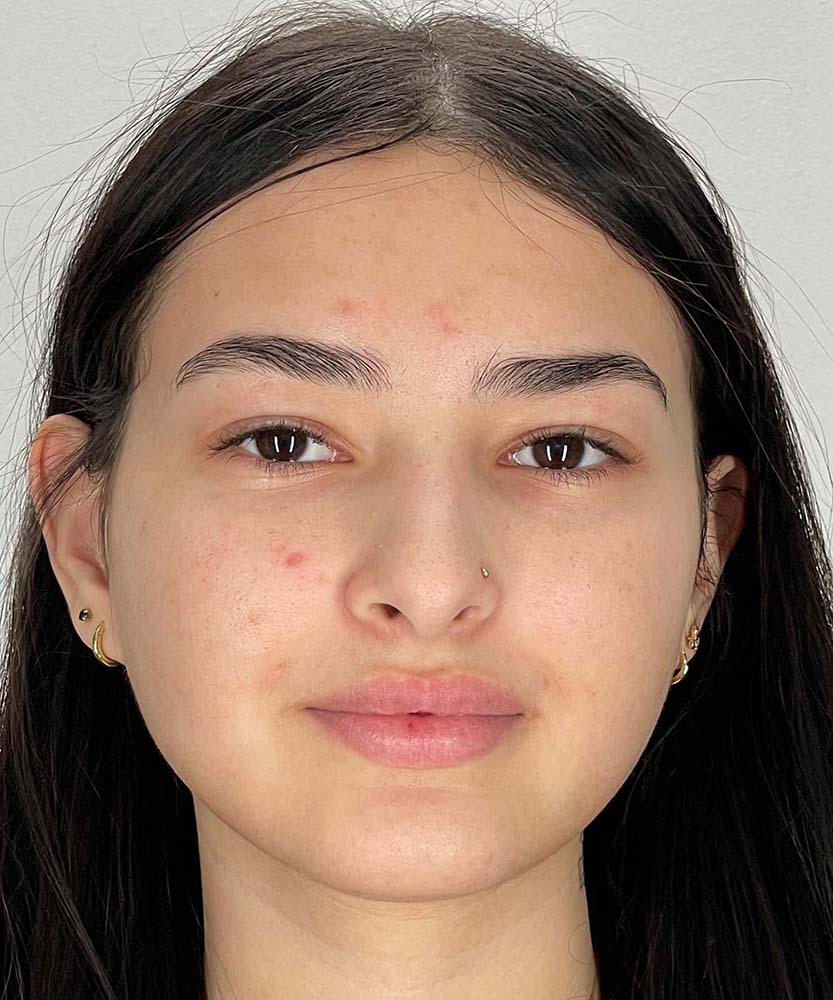 Rhinoplasty Before & After Image