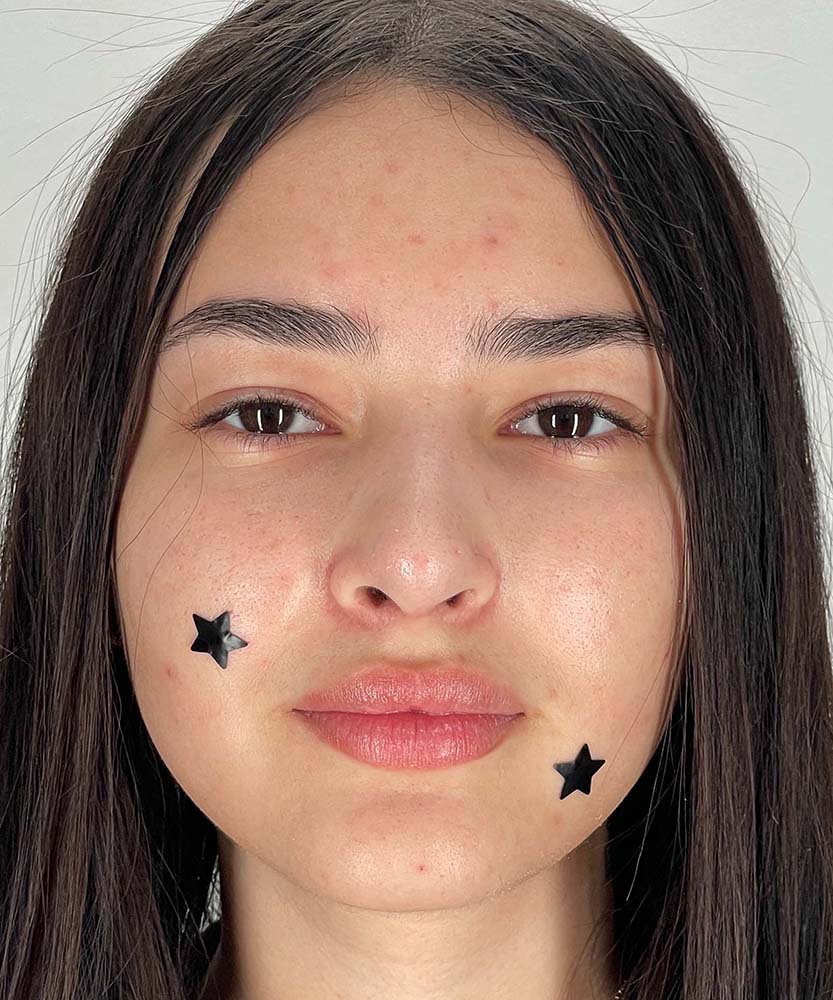 Rhinoplasty Before & After Image