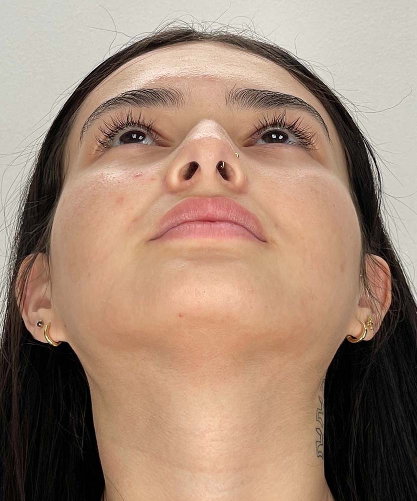 Rhinoplasty Before & After Image