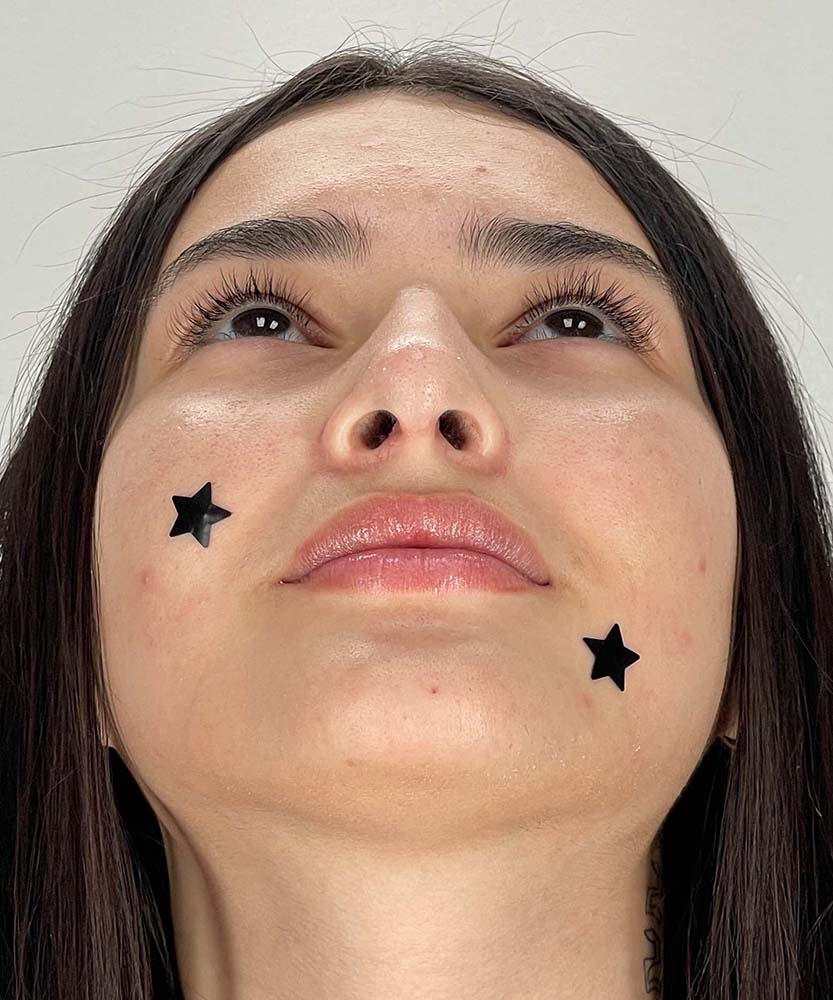 Rhinoplasty Before & After Image