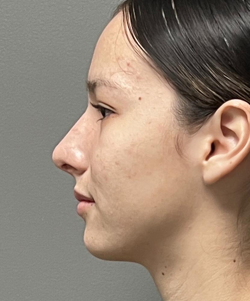 Sculptra Before & After Image