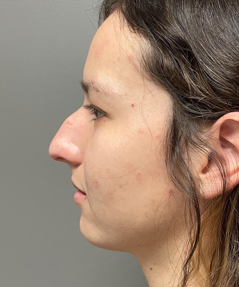 Rhinoplasty Before & After Image