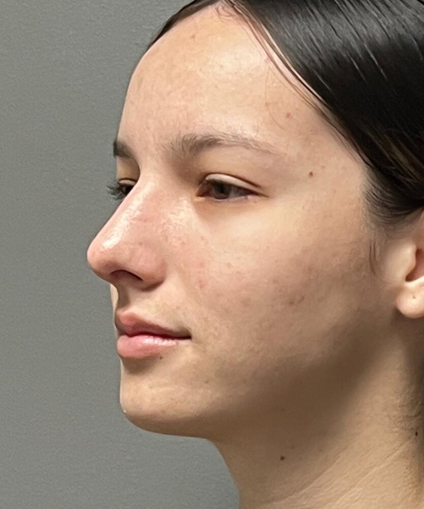 Rhinoplasty Before & After Image