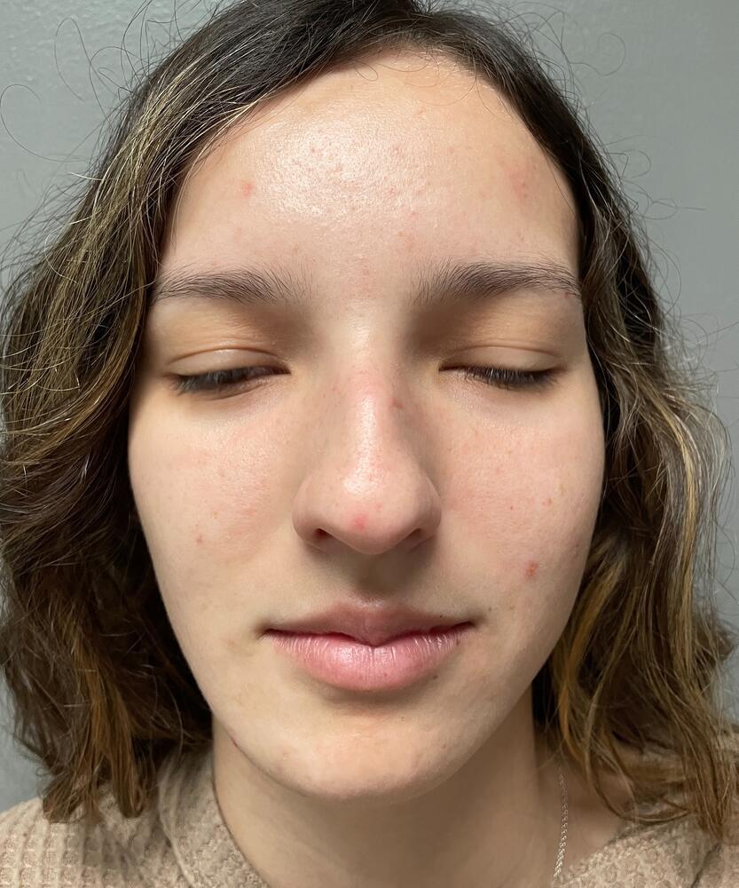 Rhinoplasty Before & After Image