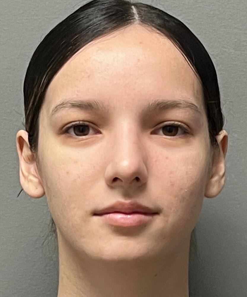 Rhinoplasty Before & After Image