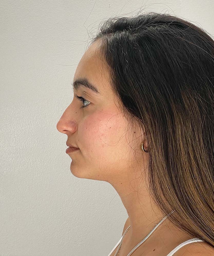 Rhinoplasty Before & After Image