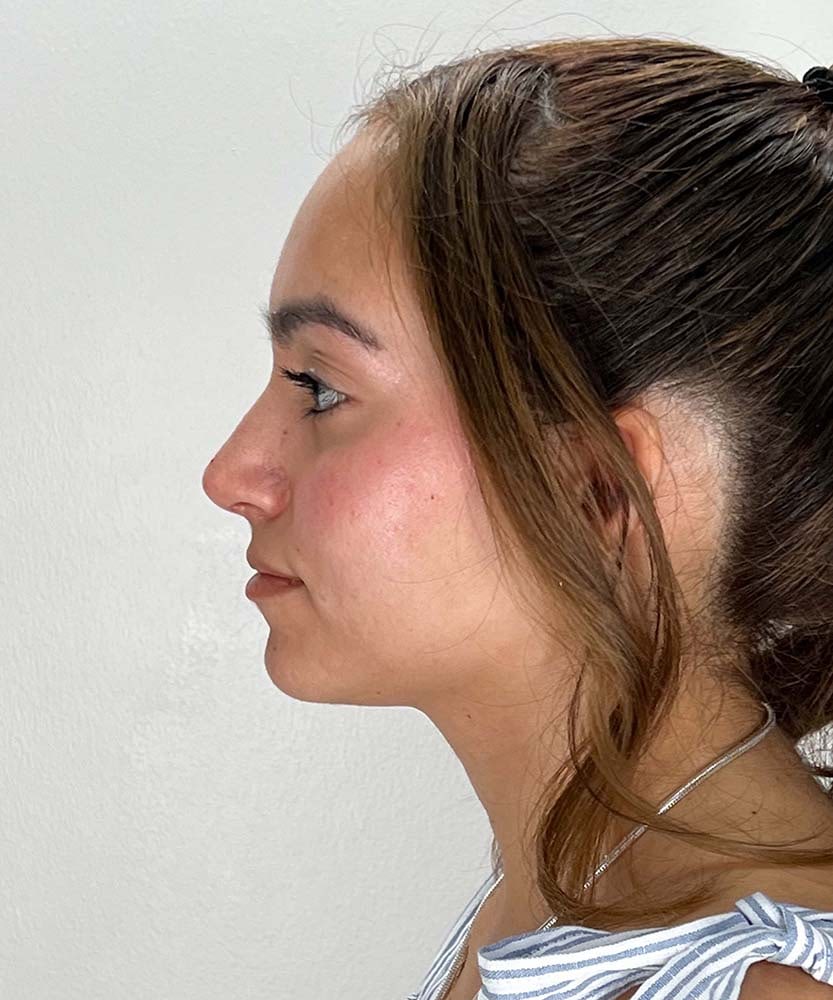 Rhinoplasty Before & After Image