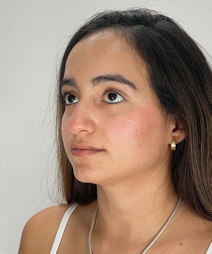 Rhinoplasty Before & After Image