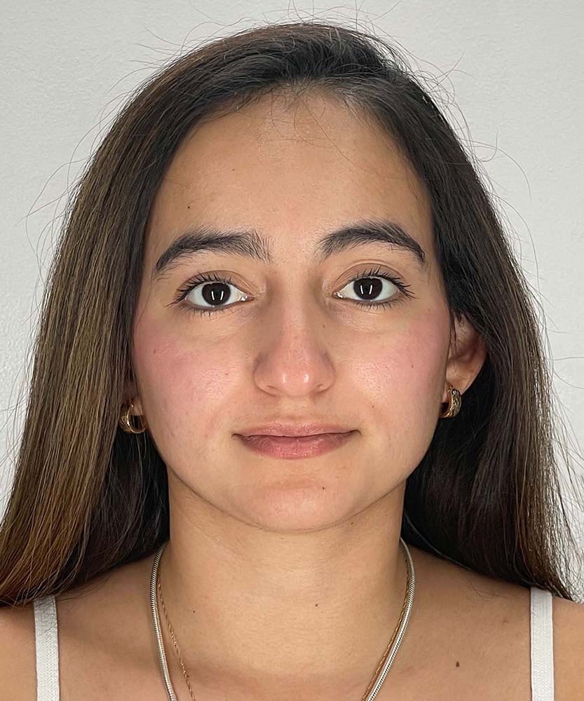 Rhinoplasty Before & After Image