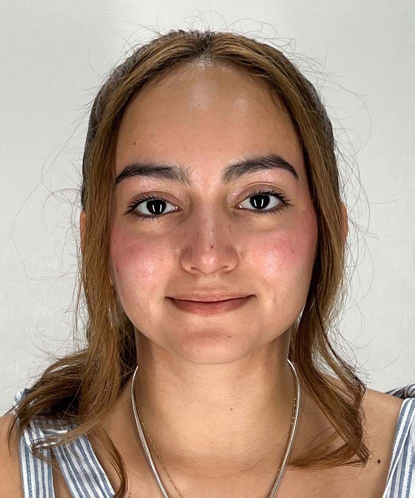 Rhinoplasty Before & After Image