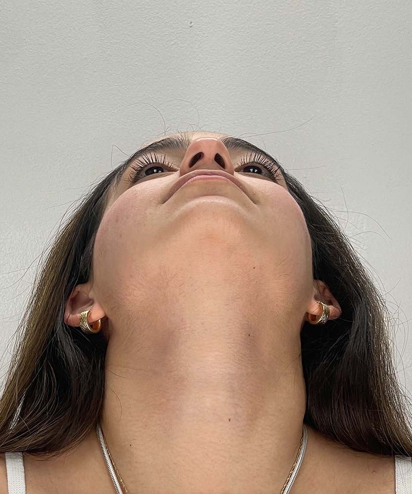 Rhinoplasty Before & After Image