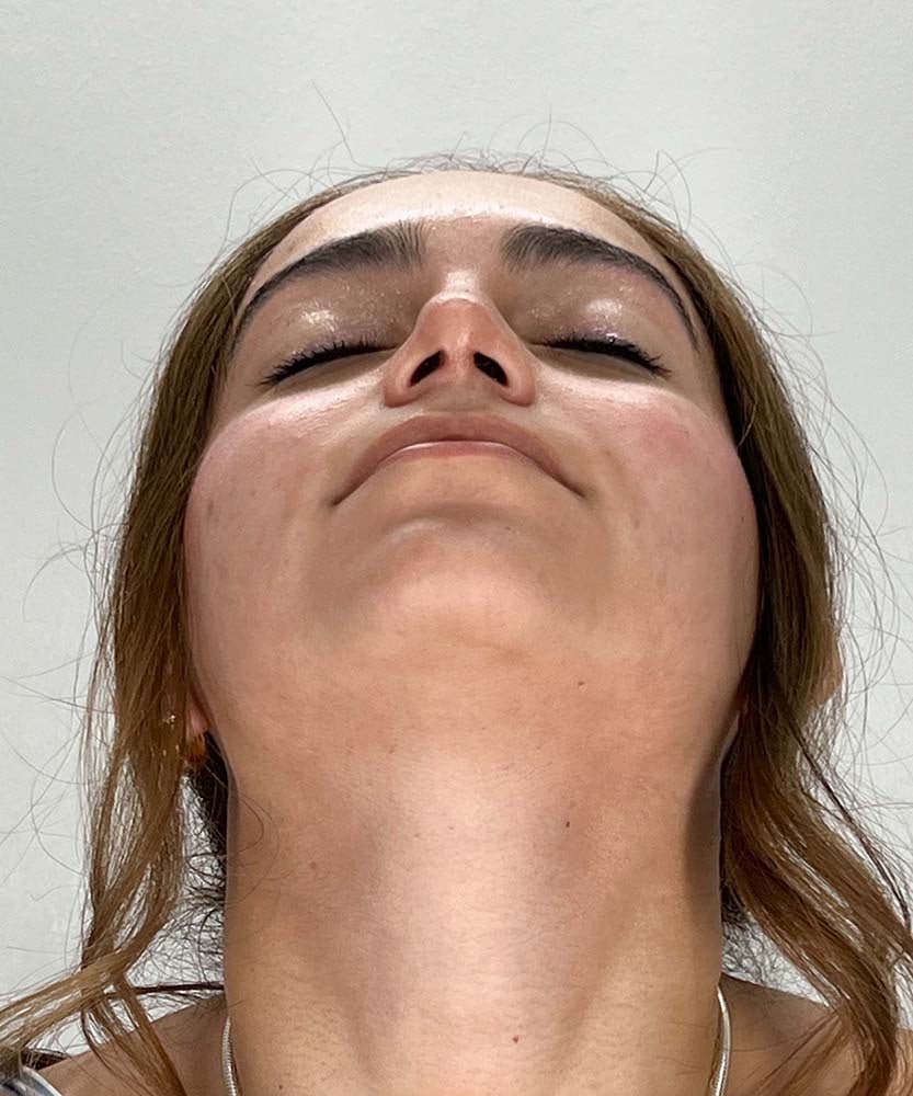 Rhinoplasty Before & After Image