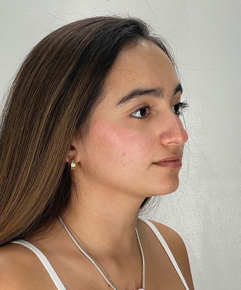 Rhinoplasty Before & After Image