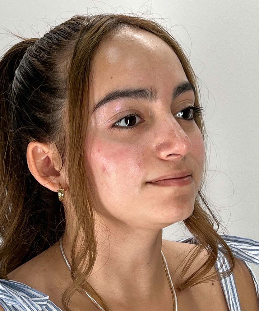Rhinoplasty Before & After Image