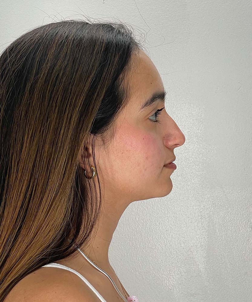 Rhinoplasty Before & After Image