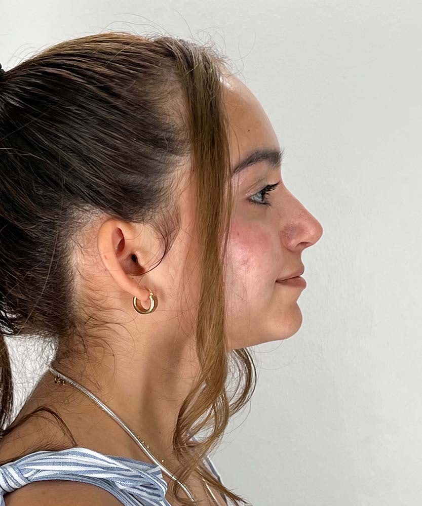 Rhinoplasty Before & After Image