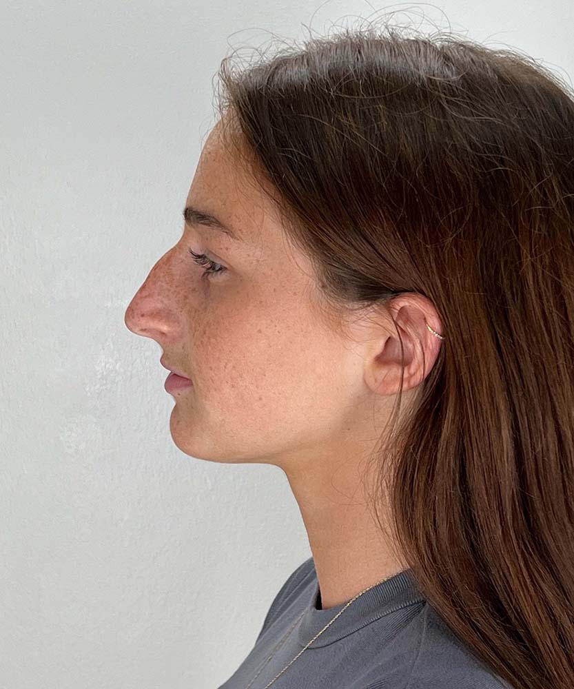 Rhinoplasty Before & After Image