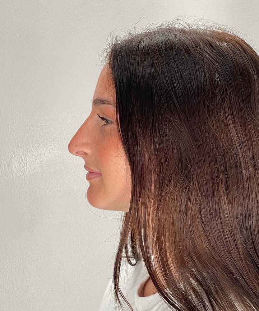 Rhinoplasty Before & After Image