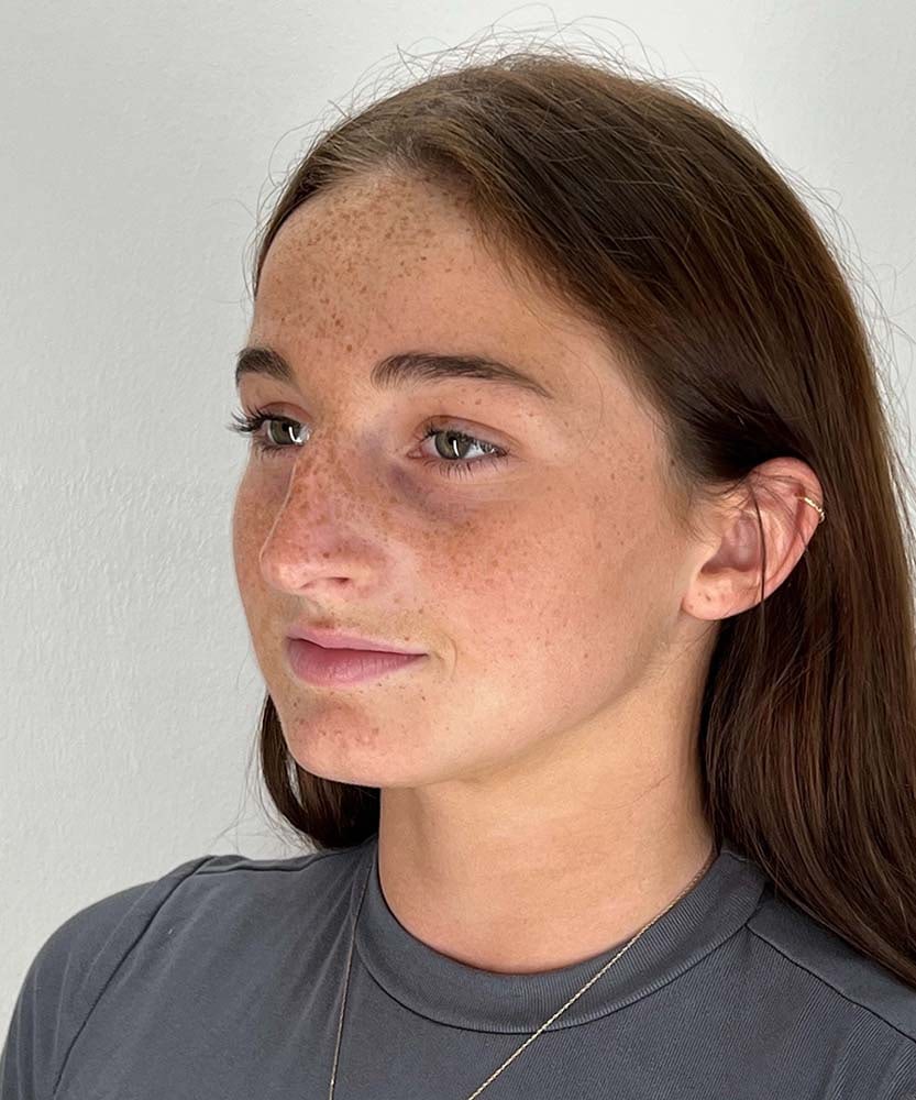 Rhinoplasty Before & After Image
