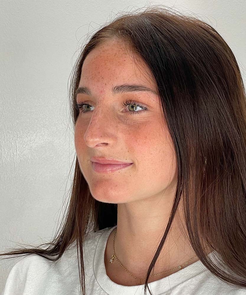 Rhinoplasty Before & After Image