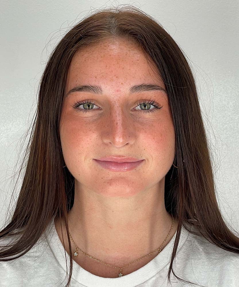 Rhinoplasty Before & After Image