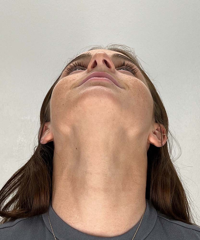 Rhinoplasty Before & After Image