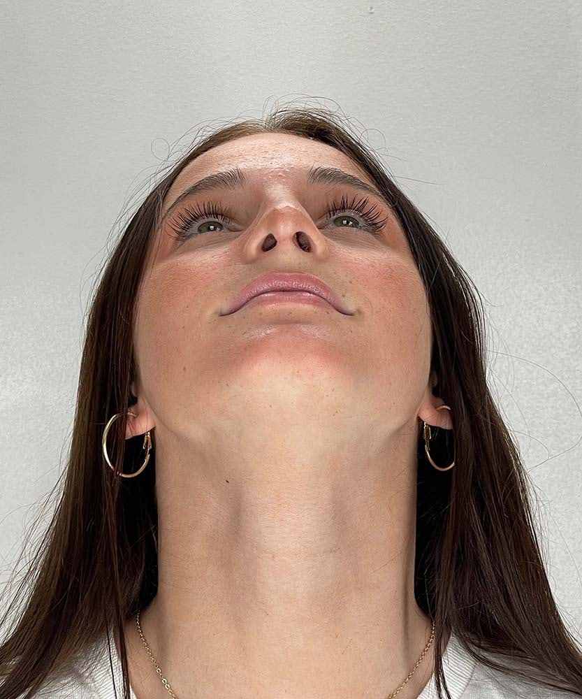Rhinoplasty Before & After Image