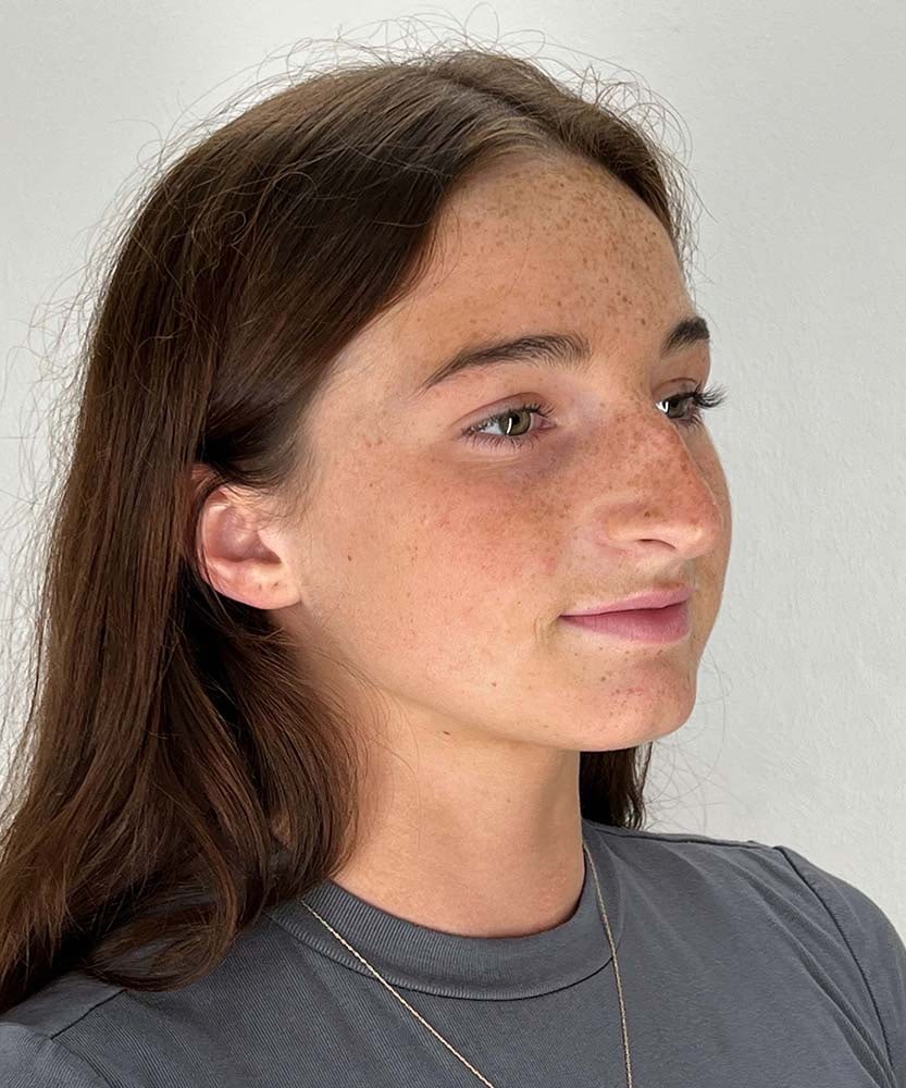 Rhinoplasty Before & After Image
