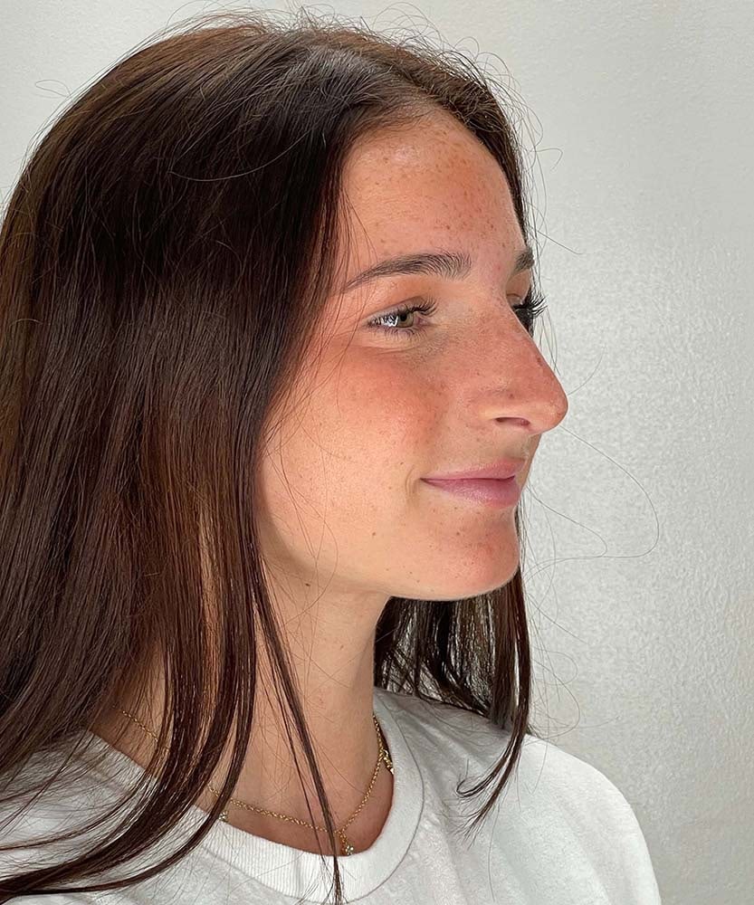 Rhinoplasty Before & After Image