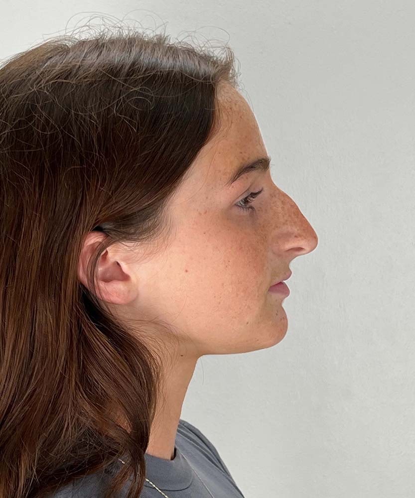 Rhinoplasty Before & After Image