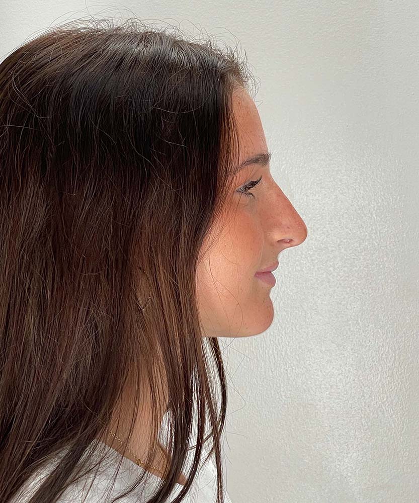 Rhinoplasty Before & After Image