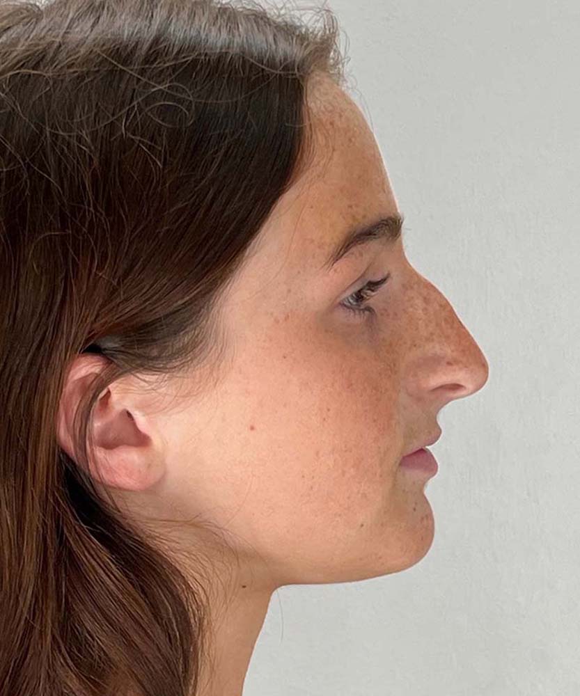 Rhinoplasty Before & After Image