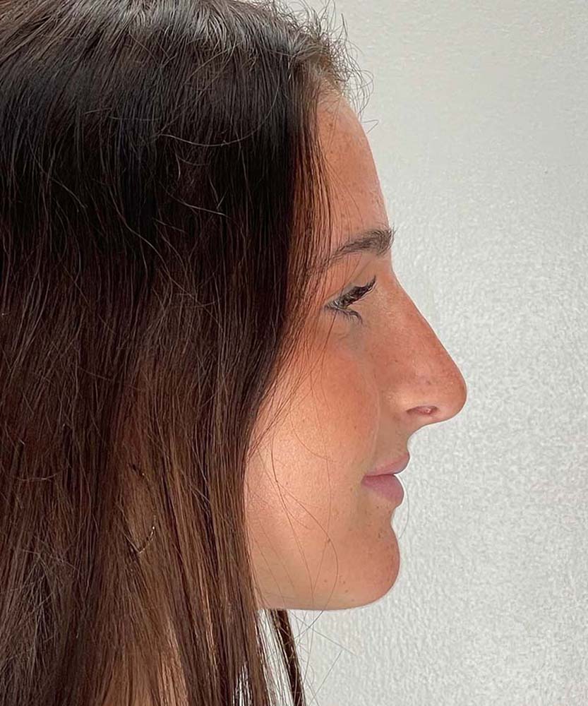 Rhinoplasty Before & After Image