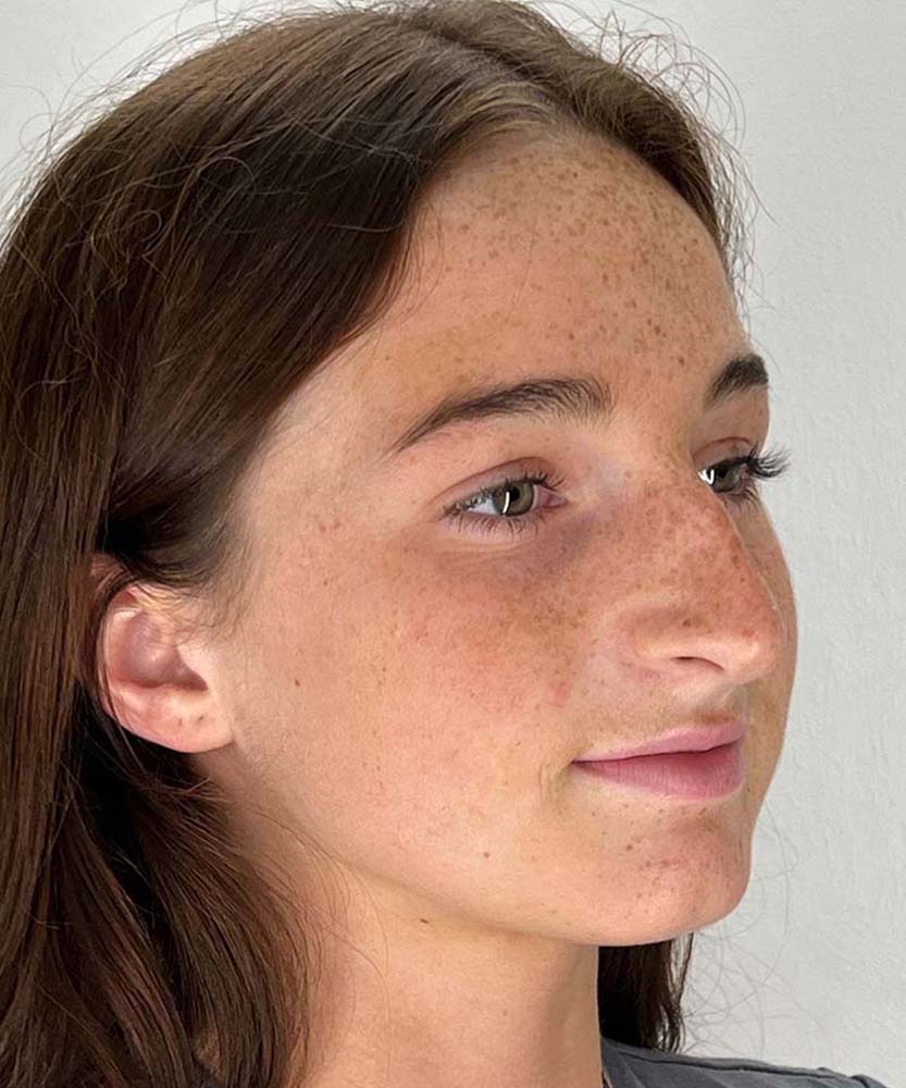 Rhinoplasty Before & After Image